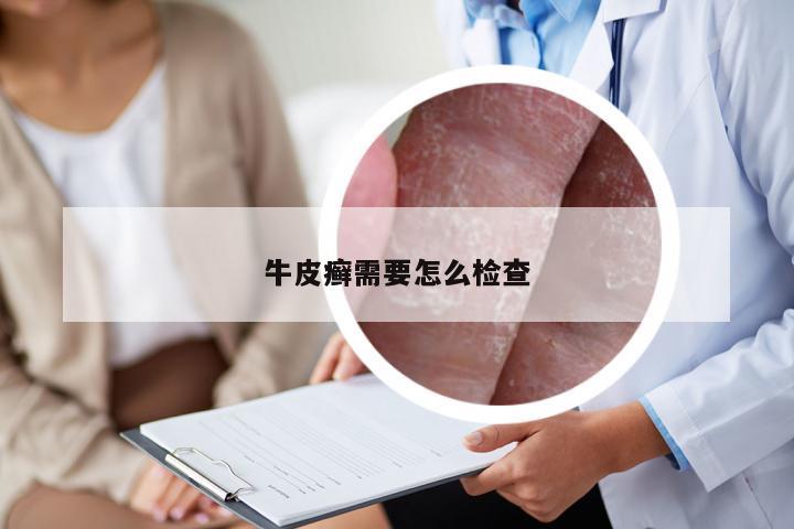 牛皮癣需要怎么检查
