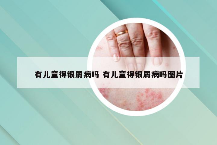 有儿童得银屑病吗 有儿童得银屑病吗图片