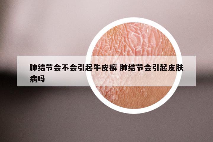 肺结节会不会引起牛皮癣 肺结节会引起皮肤病吗