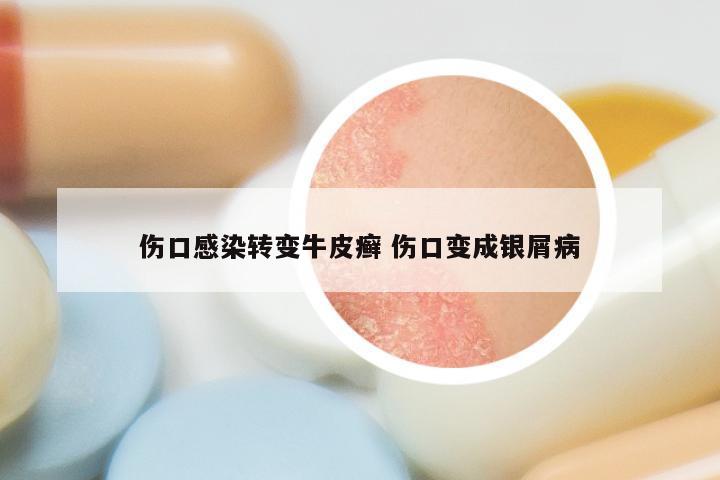 伤口感染转变牛皮癣 伤口变成银屑病