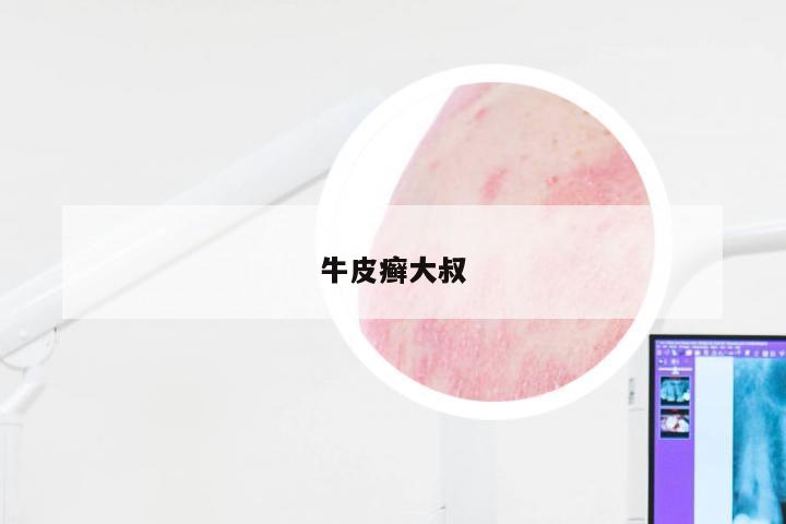 牛皮癣大叔