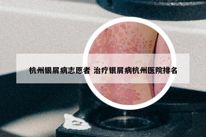 杭州银屑病志愿者 治疗银屑病杭州医院排名