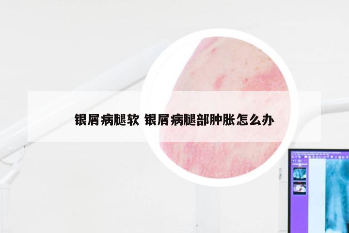 银屑病腿软 银屑病腿部肿胀怎么办