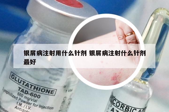 银屑病注射用什么针剂 银屑病注射什么针剂最好