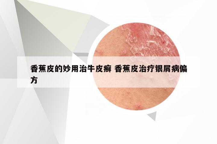 香蕉皮的妙用治牛皮癣 香蕉皮治疗银屑病偏方