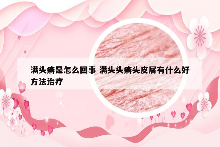 满头癣是怎么回事 满头头癣头皮屑有什么好方法治疗