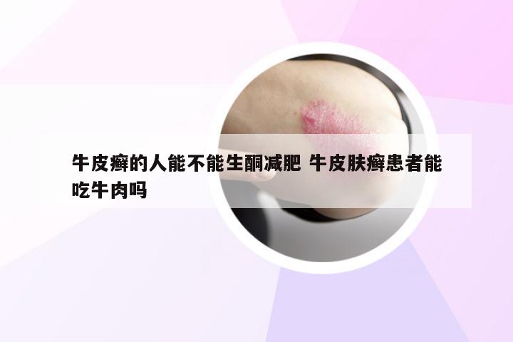 牛皮癣的人能不能生酮减肥 牛皮肤癣患者能吃牛肉吗