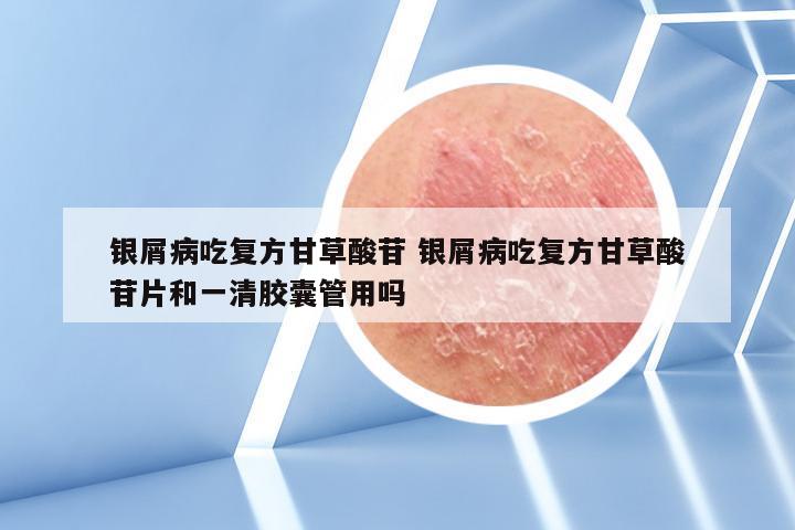 银屑病吃复方甘草酸苷 银屑病吃复方甘草酸苷片和一清胶囊管用吗