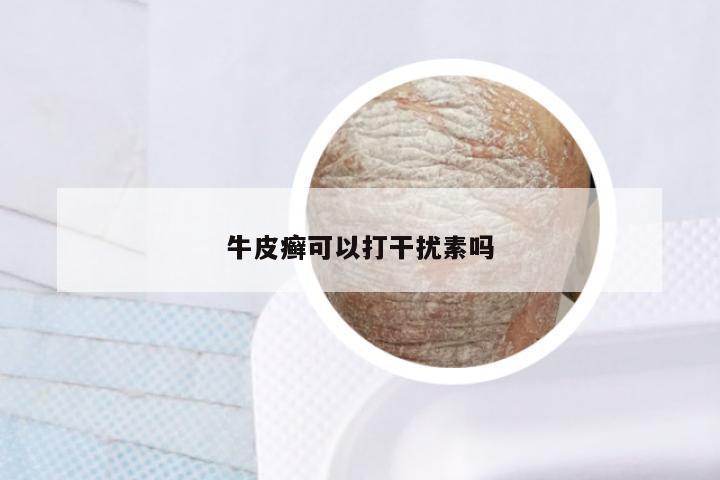 牛皮癣可以打干扰素吗