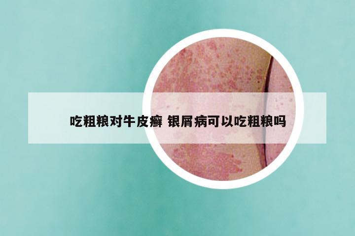 吃粗粮对牛皮癣 银屑病可以吃粗粮吗