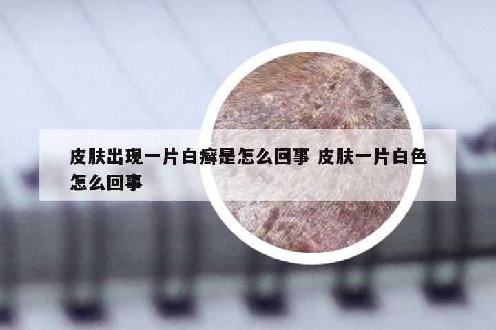 皮肤出现一片白癣是怎么回事 皮肤一片白色怎么回事