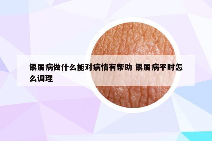 银屑病做什么能对病情有帮助 银屑病平时怎么调理