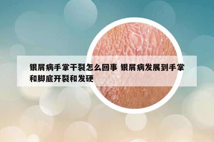 银屑病手掌干裂怎么回事 银屑病发展到手掌和脚底开裂和发硬
