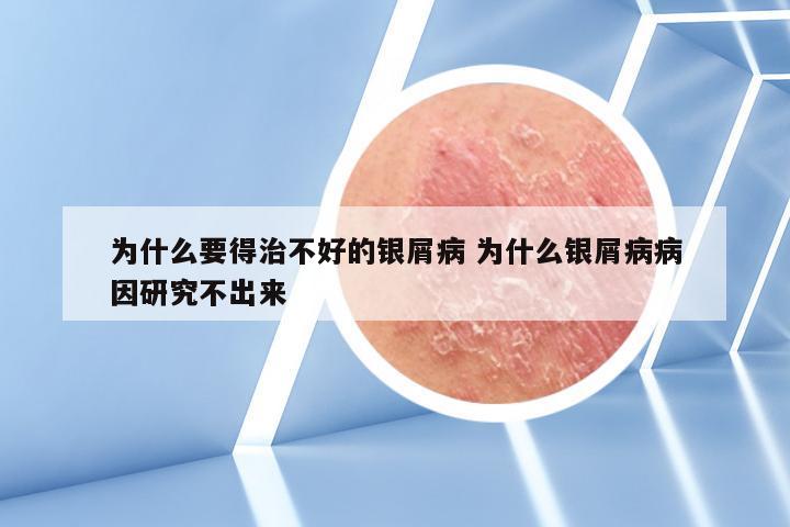 为什么要得治不好的银屑病 为什么银屑病病因研究不出来