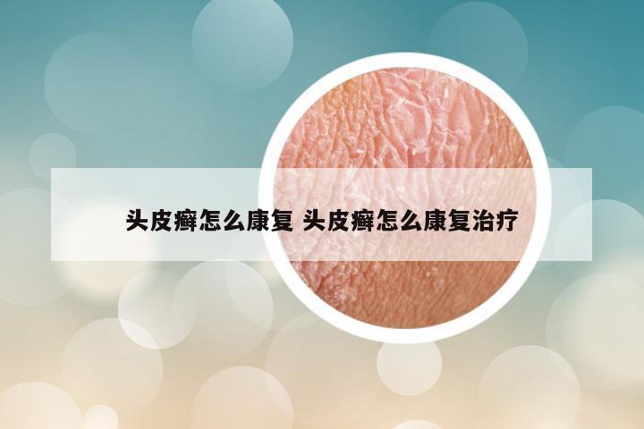 头皮癣怎么康复 头皮癣怎么康复治疗