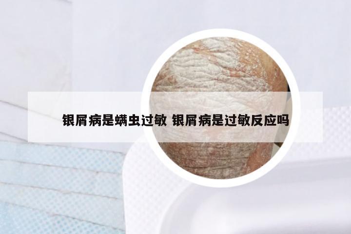银屑病是螨虫过敏 银屑病是过敏反应吗