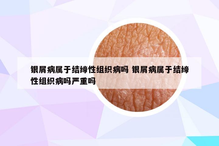 银屑病属于结缔性组织病吗 银屑病属于结缔性组织病吗严重吗