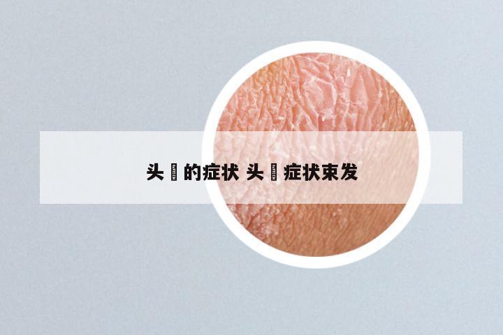 头廯的症状 头廯症状束发