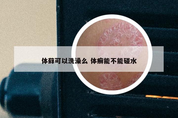 体藓可以洗澡么 体癣能不能碰水