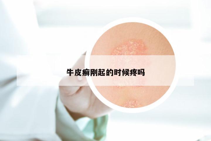牛皮癣刚起的时候疼吗