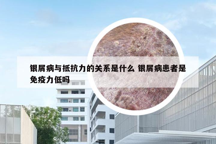 银屑病与抵抗力的关系是什么 银屑病患者是免疫力低吗