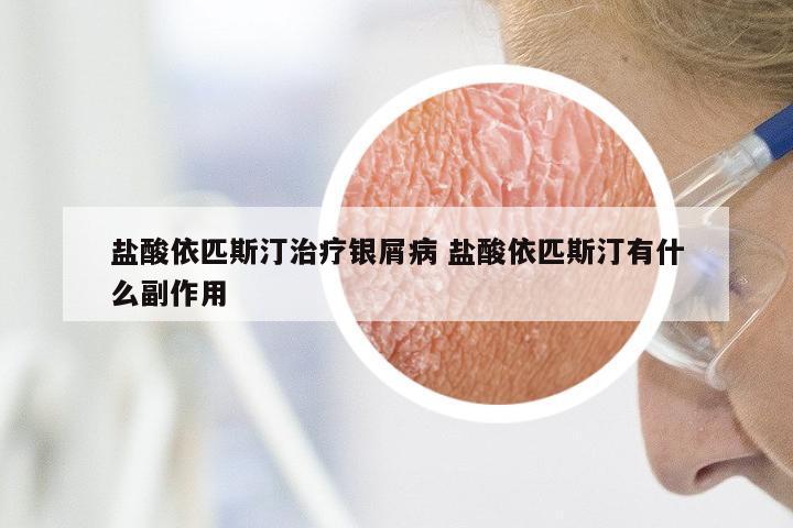 盐酸依匹斯汀治疗银屑病 盐酸依匹斯汀有什么副作用