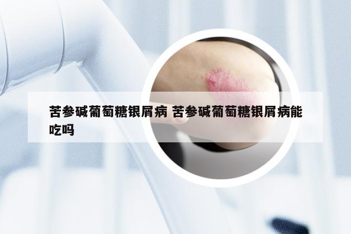 苦参碱葡萄糖银屑病 苦参碱葡萄糖银屑病能吃吗