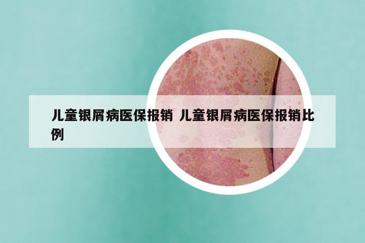 儿童银屑病医保报销 儿童银屑病医保报销比例