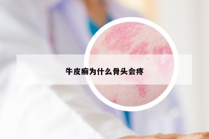 牛皮癣为什么骨头会疼