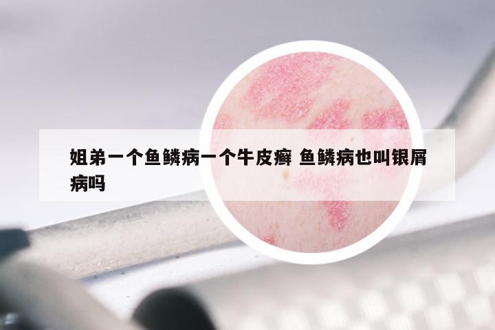 姐弟一个鱼鳞病一个牛皮癣 鱼鳞病也叫银屑病吗