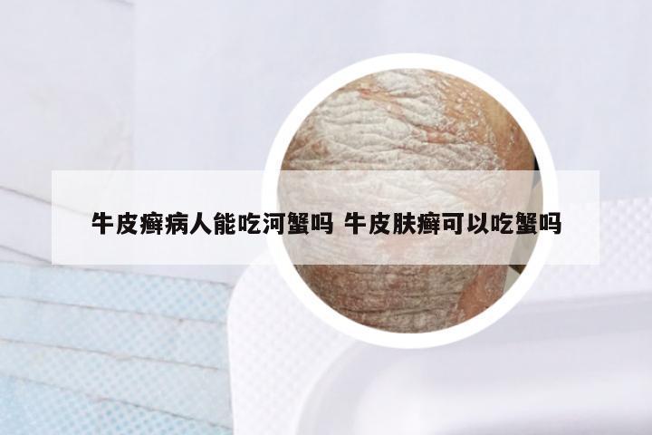 牛皮癣病人能吃河蟹吗 牛皮肤癣可以吃蟹吗