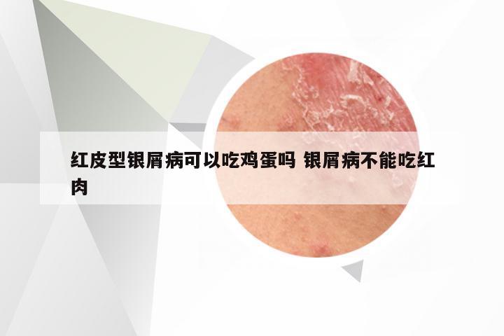 红皮型银屑病可以吃鸡蛋吗 银屑病不能吃红肉