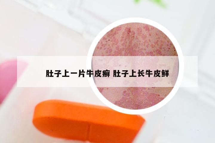 肚子上一片牛皮癣 肚子上长牛皮鲜