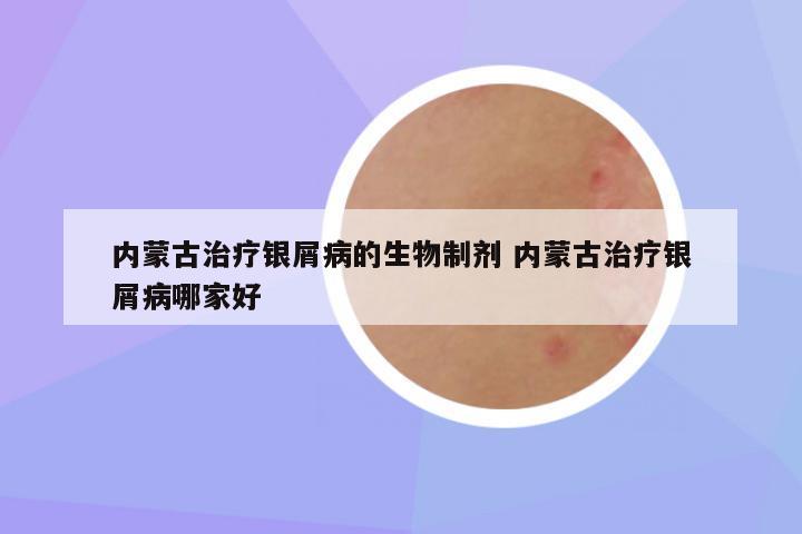 内蒙古治疗银屑病的生物制剂 内蒙古治疗银屑病哪家好