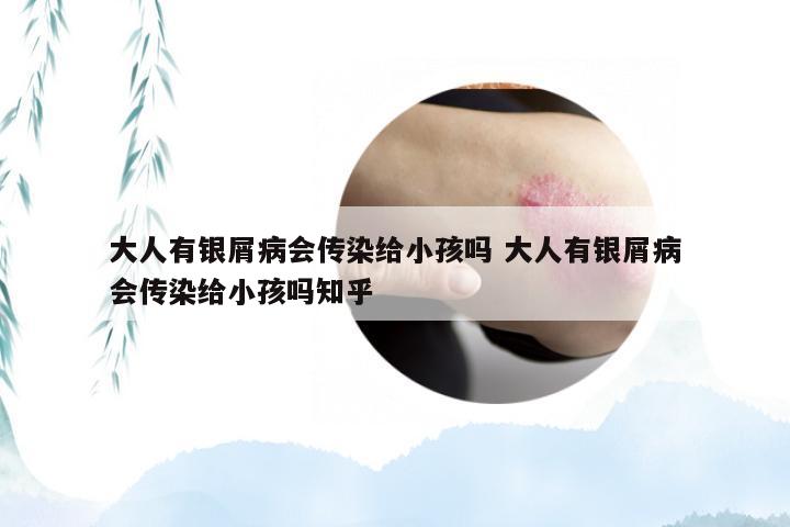大人有银屑病会传染给小孩吗 大人有银屑病会传染给小孩吗知乎