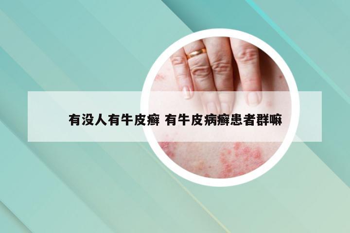 有没人有牛皮癣 有牛皮病癣患者群嘛