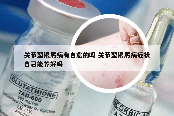 关节型银屑病有自愈的吗 关节型银屑病症状自己能养好吗