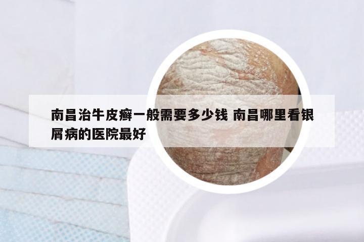 南昌治牛皮癣一般需要多少钱 南昌哪里看银屑病的医院最好