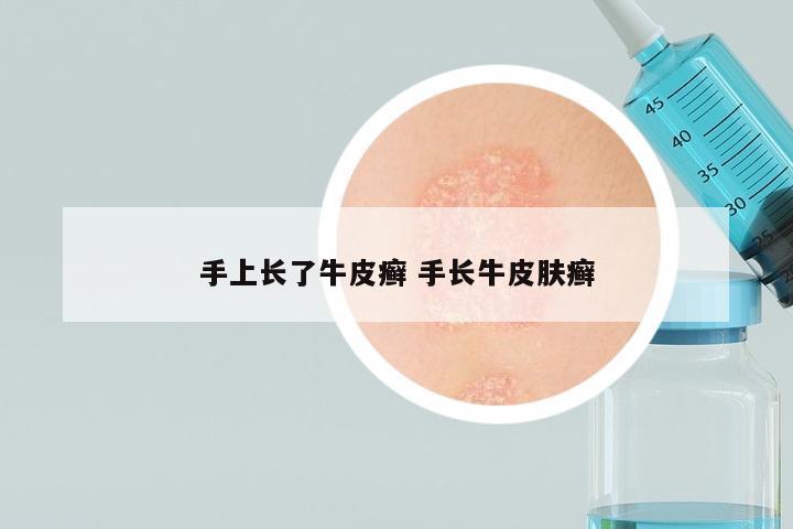 手上长了牛皮癣 手长牛皮肤癣