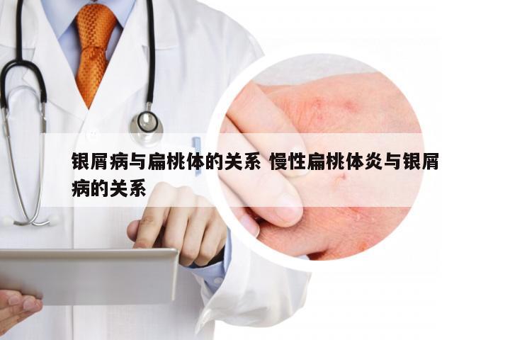 银屑病与扁桃体的关系 慢性扁桃体炎与银屑病的关系