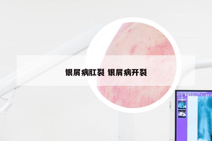 银屑病肛裂 银屑病开裂
