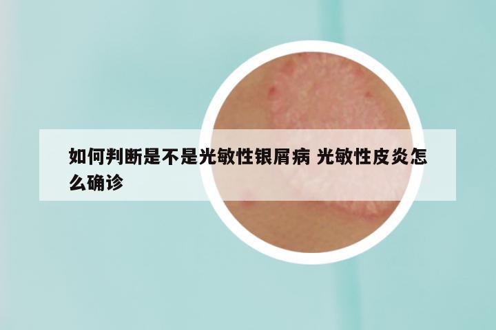 如何判断是不是光敏性银屑病 光敏性皮炎怎么确诊