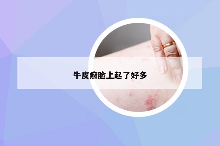 牛皮癣脸上起了好多