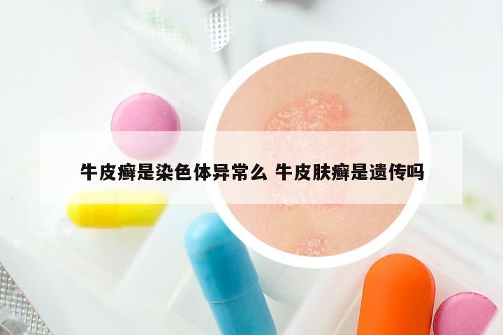 牛皮癣是染色体异常么 牛皮肤癣是遗传吗