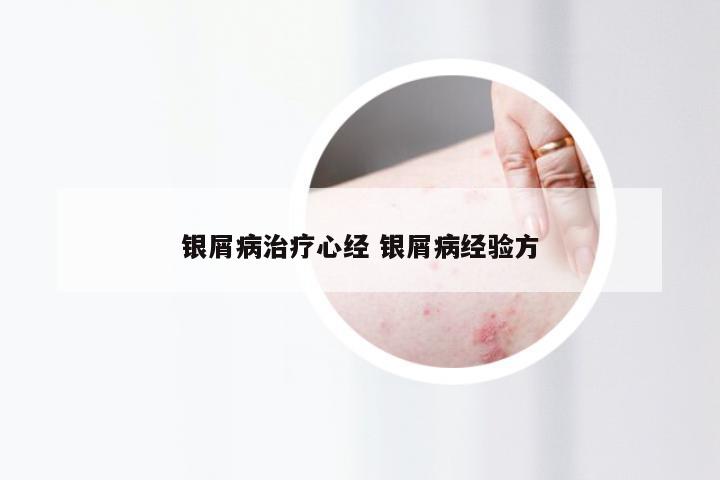 银屑病治疗心经 银屑病经验方