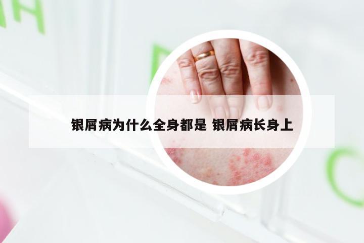 银屑病为什么全身都是 银屑病长身上