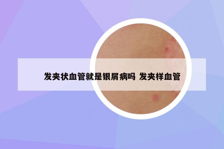 发夹状血管就是银屑病吗 发夹样血管