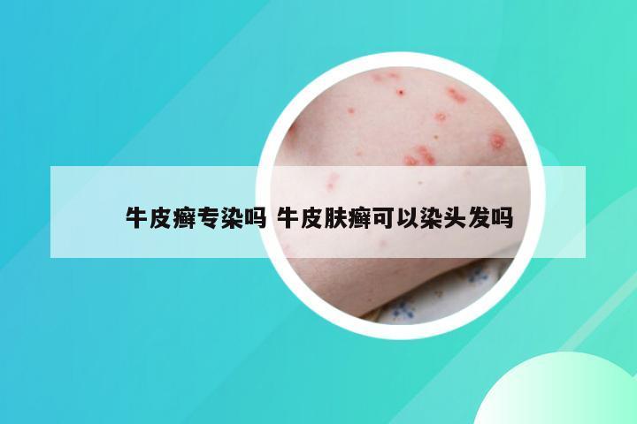 牛皮癣专染吗 牛皮肤癣可以染头发吗