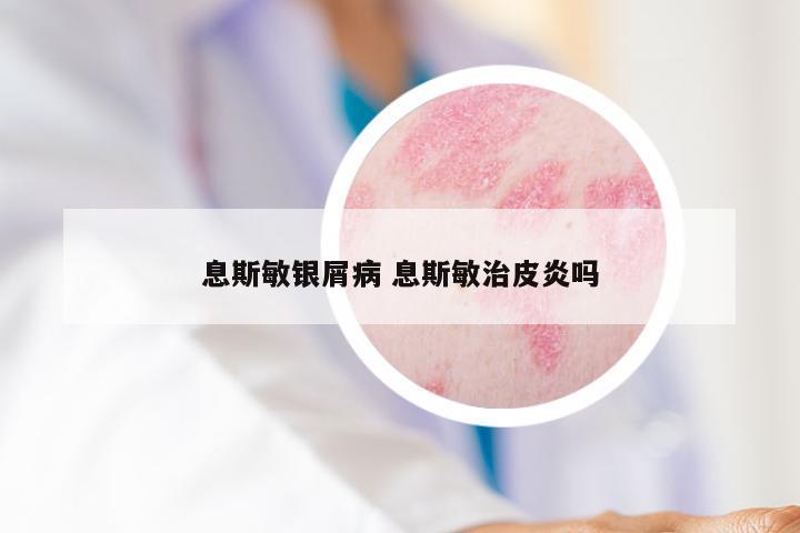 息斯敏银屑病 息斯敏治皮炎吗