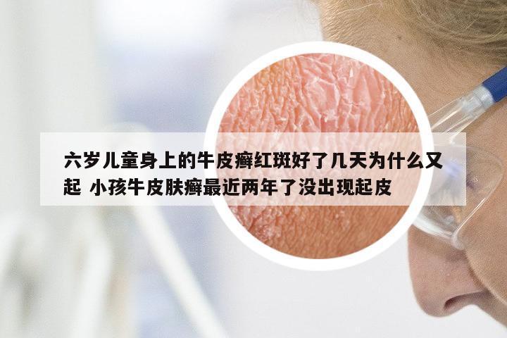 六岁儿童身上的牛皮癣红斑好了几天为什么又起 小孩牛皮肤癣最近两年了没出现起皮